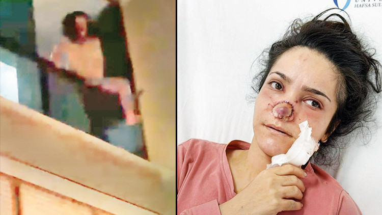 Burnu ısırılıp koparılan İmran: Acıdan atlamayı düşündüm Burnu ısırılıp koparılan İmran: Acıdan atlamayı düşündüm