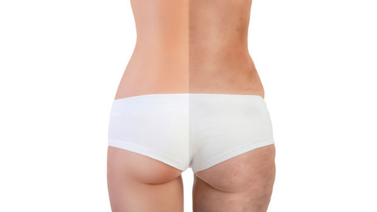 Sivilce lekeleri nasıl geçer Sivilce izlerine ne iyi gelir Evde sivilce lekelerini geçiren bitkisel çözümler ve doğal yöntemler