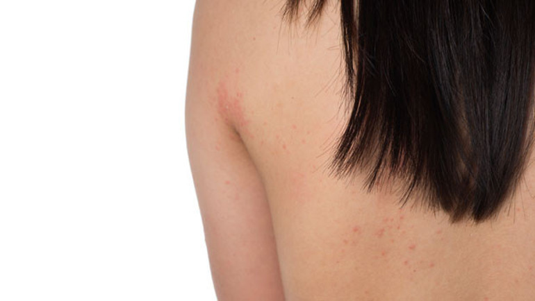 Sivilce lekeleri nasıl geçer Sivilce izlerine ne iyi gelir Evde sivilce lekelerini geçiren bitkisel çözümler ve doğal yöntemler