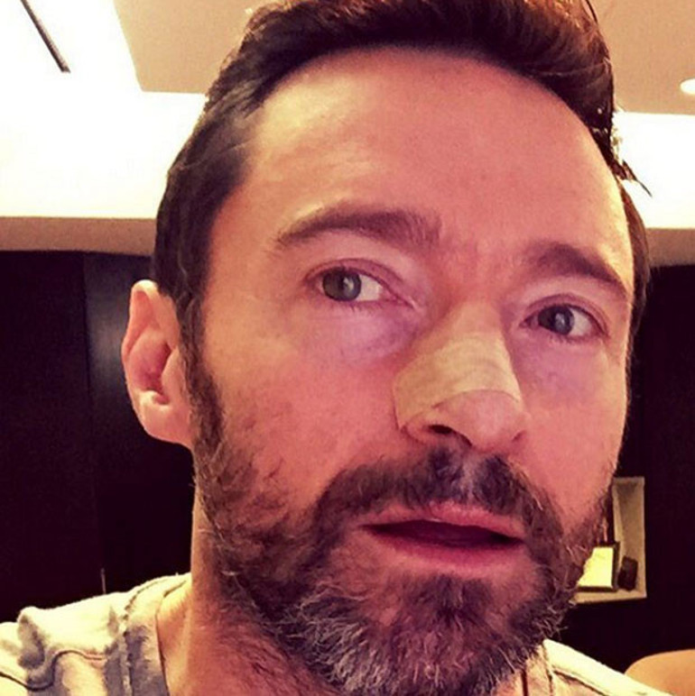 Hugh Jackman: Güneş kremi sürmezseniz benim gibi kansere yakalanırsınız