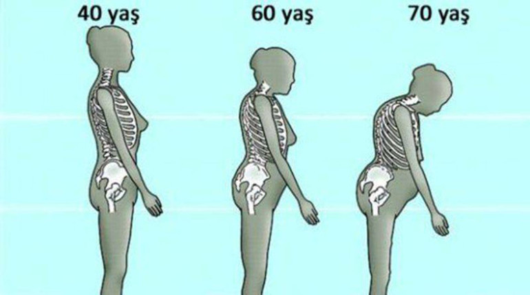 Kemik erimesi (osteoporoz) hayatınızı zehir etmesin