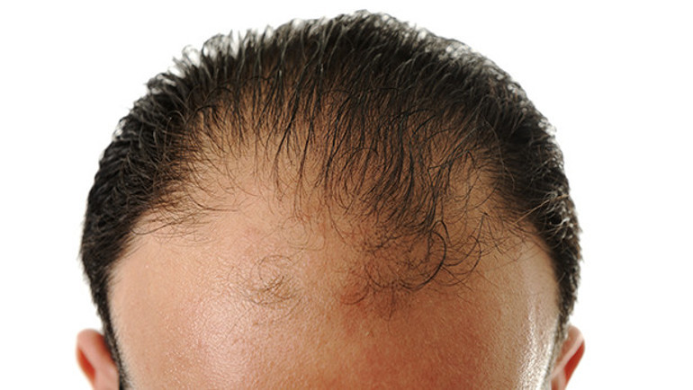 Türkiye saç ekiminde neden lider