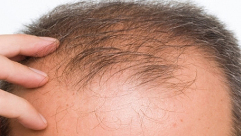 Türkiye saç ekiminde neden lider