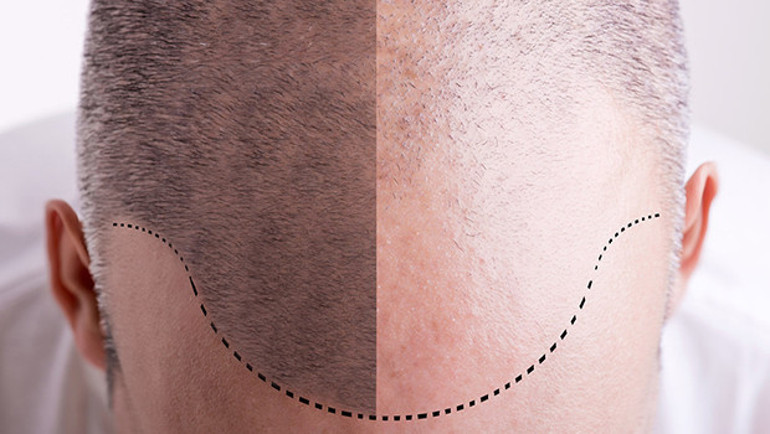 Türkiye saç ekiminde neden lider