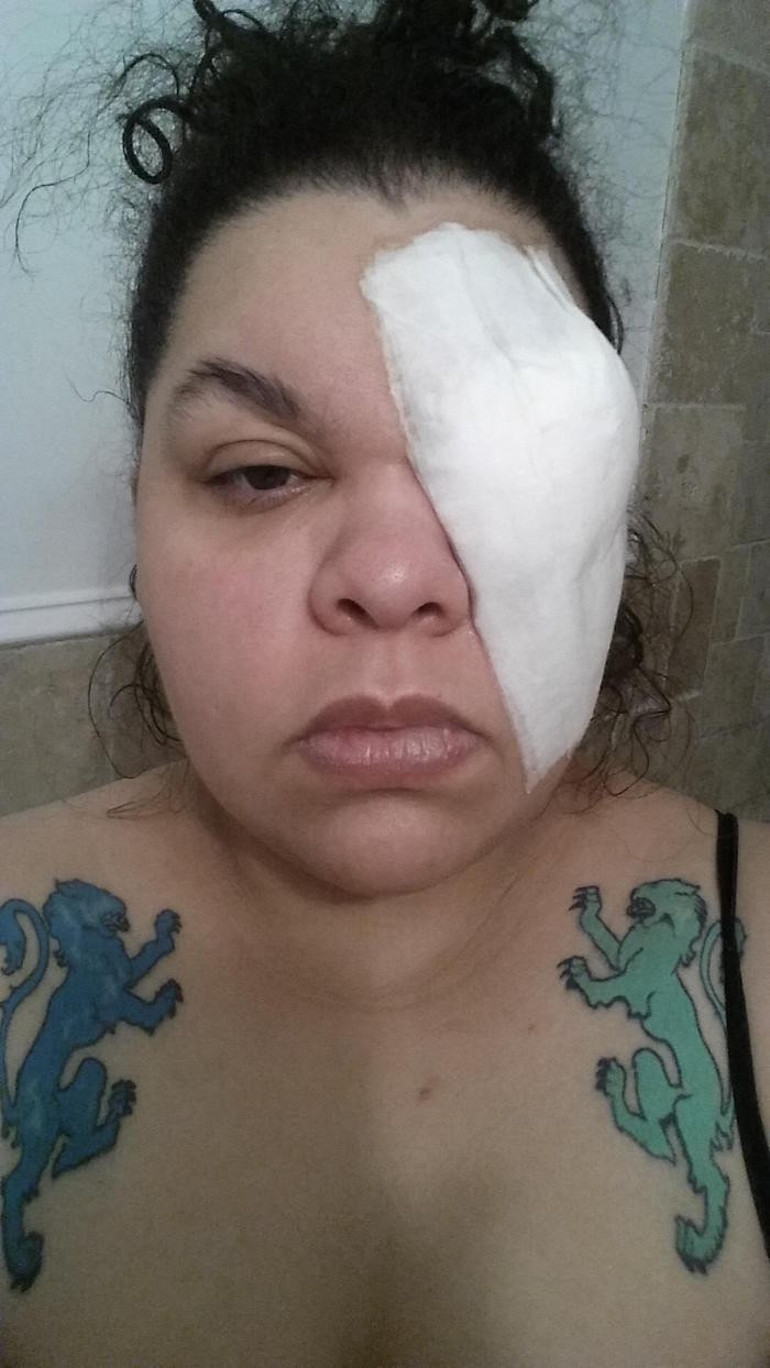 Simli göz farı genç kadını gözünden etti