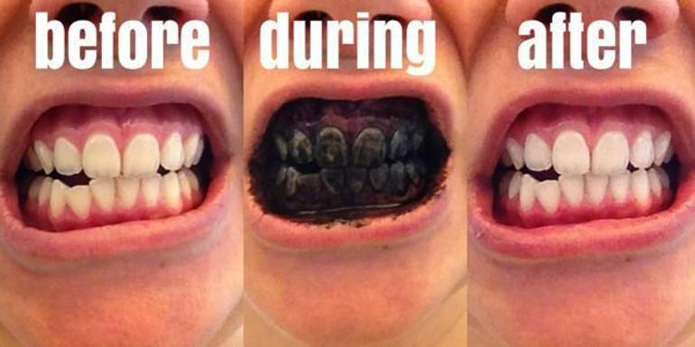 Dişleri kömürle fırçalamak moda oldu, uzmanlar uyardı