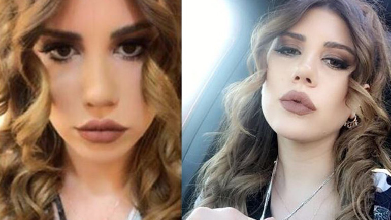 Kısmetse Olur Melis burnunun yeni halini İnstagramda paylaştı - İşte estetikli Melis