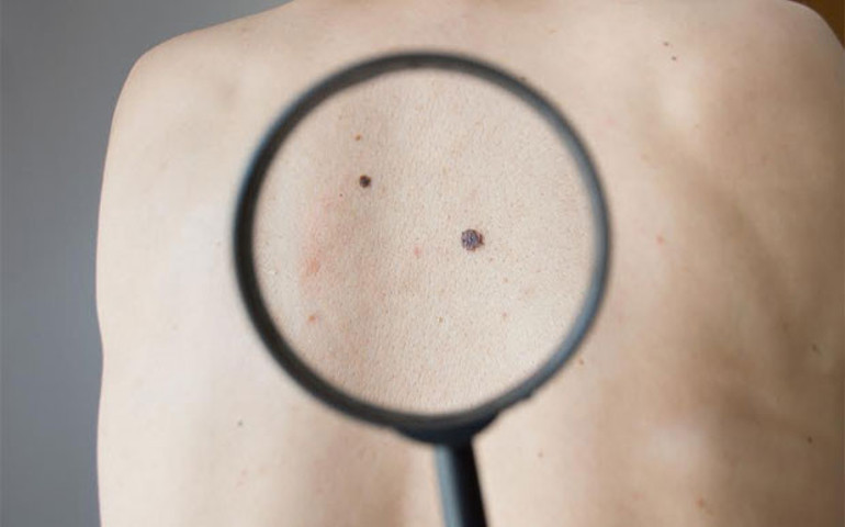 Saat başı 1 kişi melanomdan ölüyor