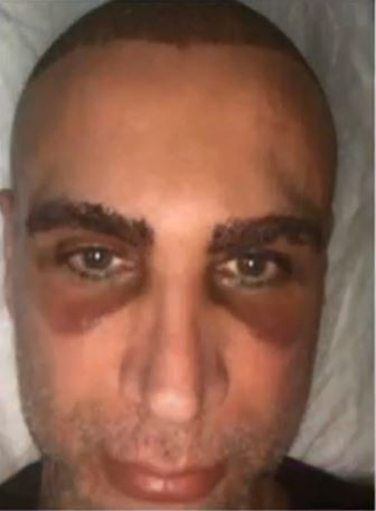 Şarkıcı Doğuş saç ektirdi... İşte son hali