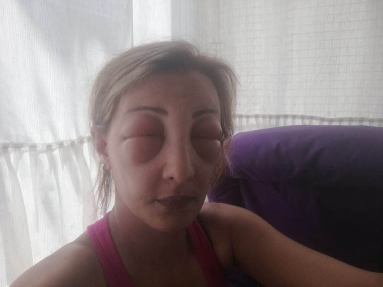 Saçlarını yaptırmak için kuaföre gitti, canından oluyordu Yüzü tanınmayacak hale geldi...