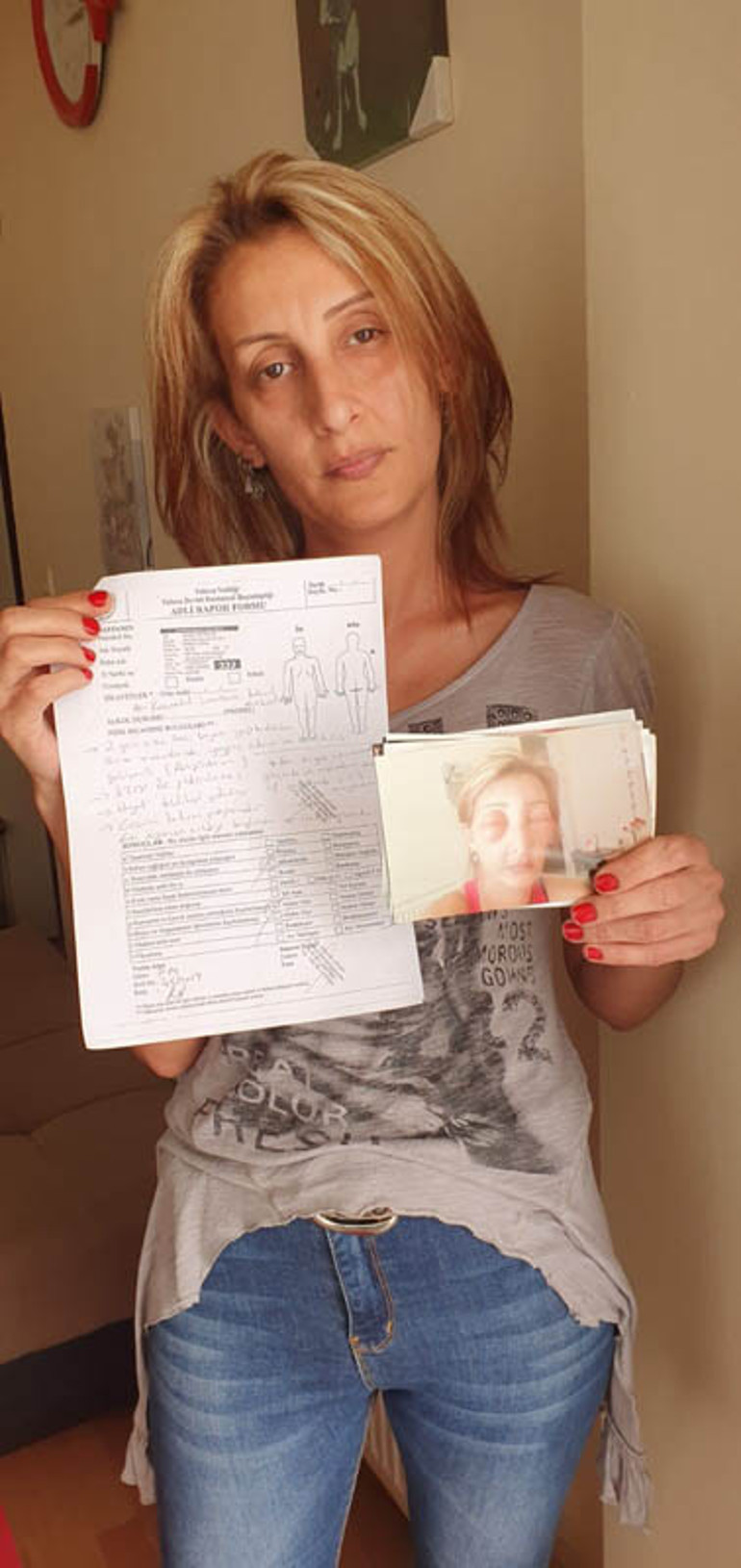 Saçlarını yaptırmak için kuaföre gitti, canından oluyordu Yüzü tanınmayacak hale geldi...