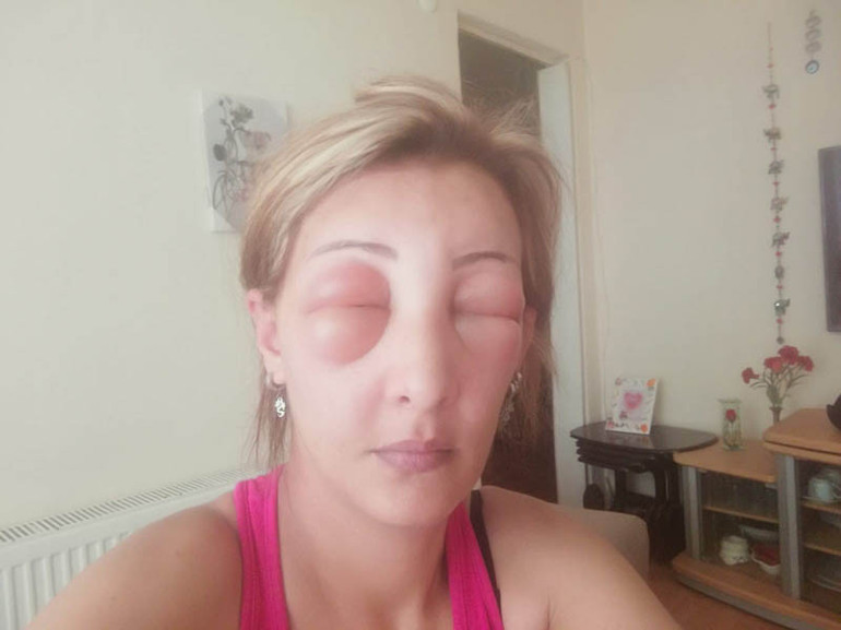 Saçlarını yaptırmak için kuaföre gitti, canından oluyordu Yüzü tanınmayacak hale geldi...