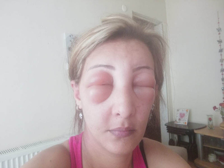 Saçlarını yaptırmak için kuaföre gitti, canından oluyordu Yüzü tanınmayacak hale geldi...