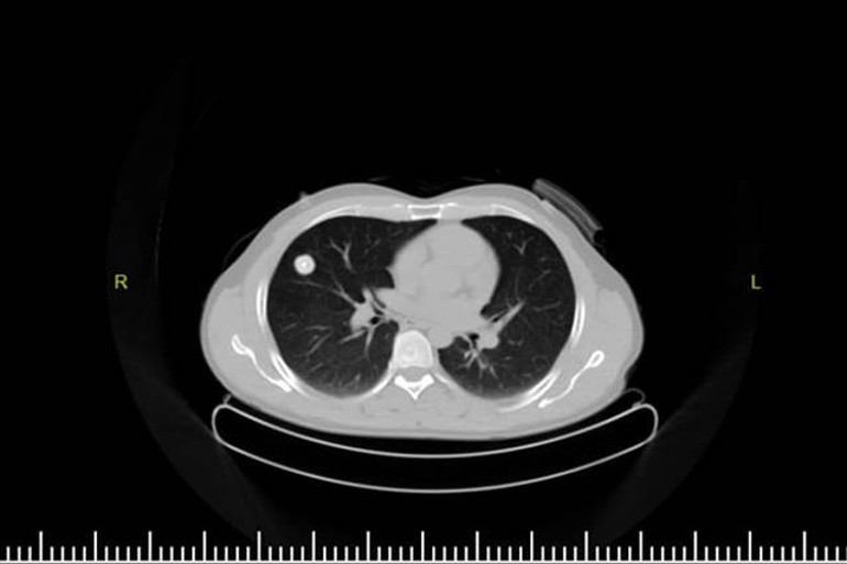 Kanser şüphesiyle ameliyat oldu Akciğerinden böcek çıktı