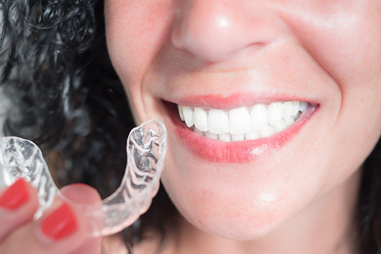 Ortodontide saklı tel tedavisi nedir