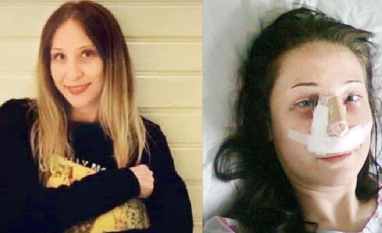 Burun Estetiği Ameliyatları Sonrası Nelere Dikkat Edilmeli