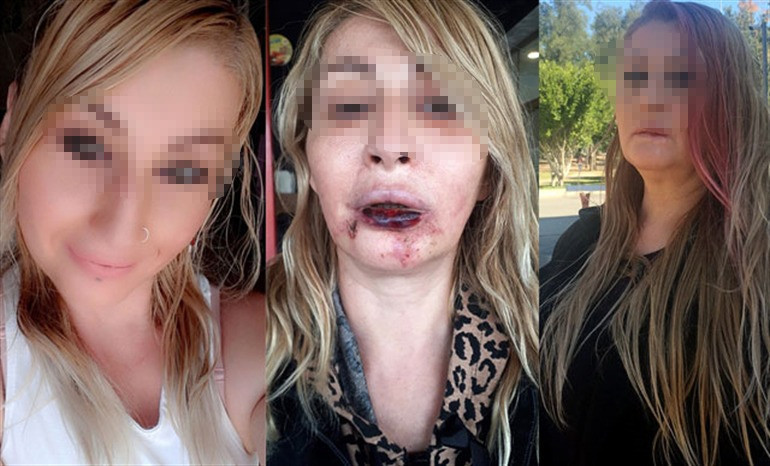 5 büyük hata... Estetik operasyonlarda mağdur olmamak için dikkat