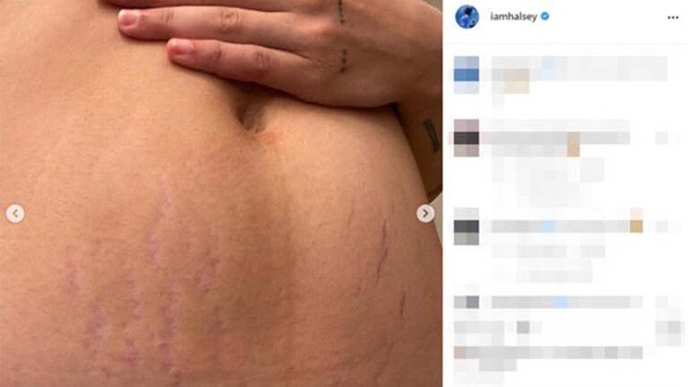 Halsey doğum sonrası oluşan çatlaklarını paylaştı: Her şey göründüğü gibi