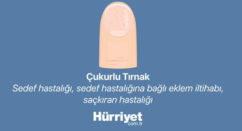 Bana tırnağını göster sana hastalığını söyleyeyim | Milyonlarca izlenen videodan sonra gündem tırnaklar...