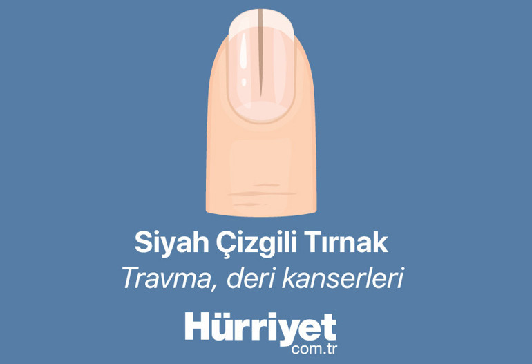 Bana tırnağını göster sana hastalığını söyleyeyim | Milyonlarca izlenen videodan sonra gündem tırnaklar...