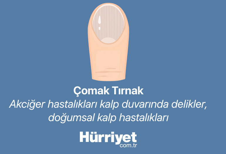 Bana tırnağını göster sana hastalığını söyleyeyim | Milyonlarca izlenen videodan sonra gündem tırnaklar...