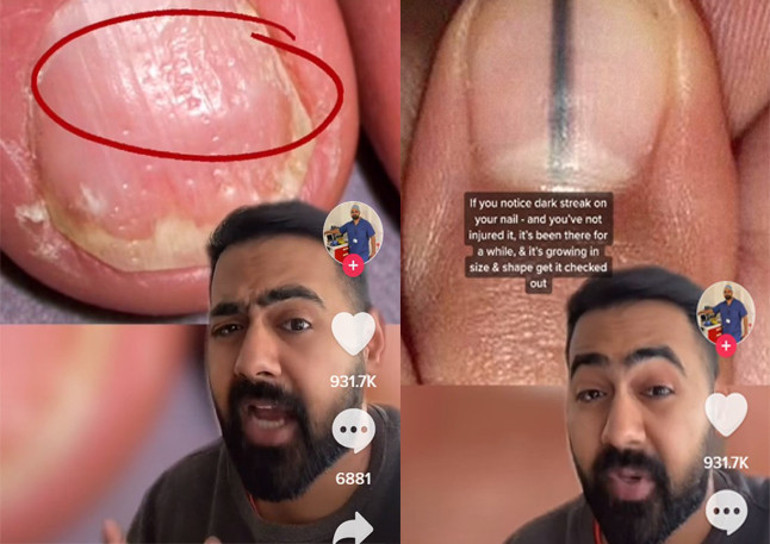 Bana tırnağını göster sana hastalığını söyleyeyim | Milyonlarca izlenen videodan sonra gündem tırnaklar...