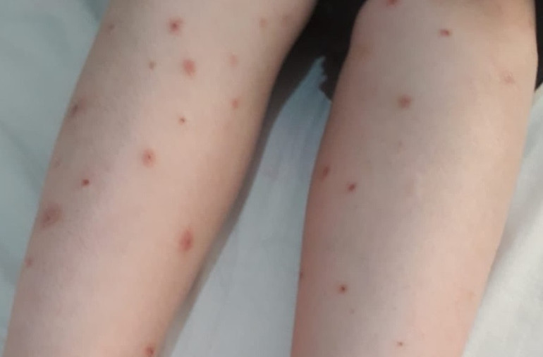 Ah, karasinek ısırdı... diyoruz ama onlar karasinek değil İşte İstanbullunun yeni derdi...