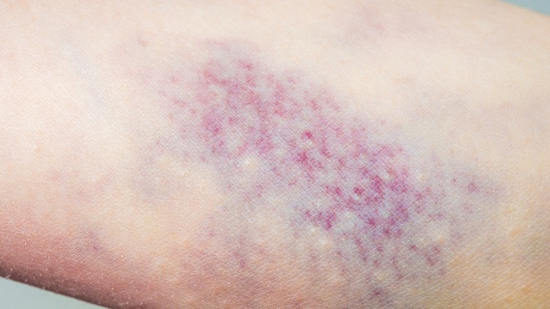 Peteşi nedir, neden olur Peteşi hastalığı belirtileri ve tedavisi