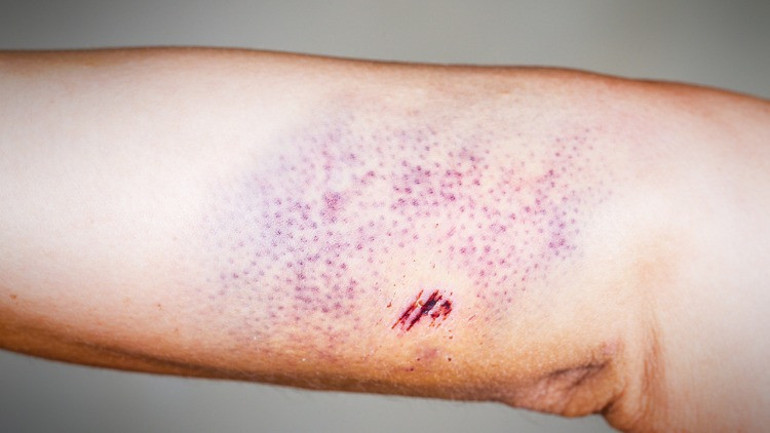 Peteşi nedir, neden olur Peteşi hastalığı belirtileri ve tedavisi