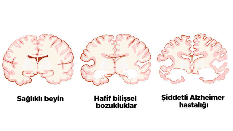 Hasta ve hasta yakını milyonlarca kişiyi ilgilendiriyor... Aşı Alzheimera umut olur mu