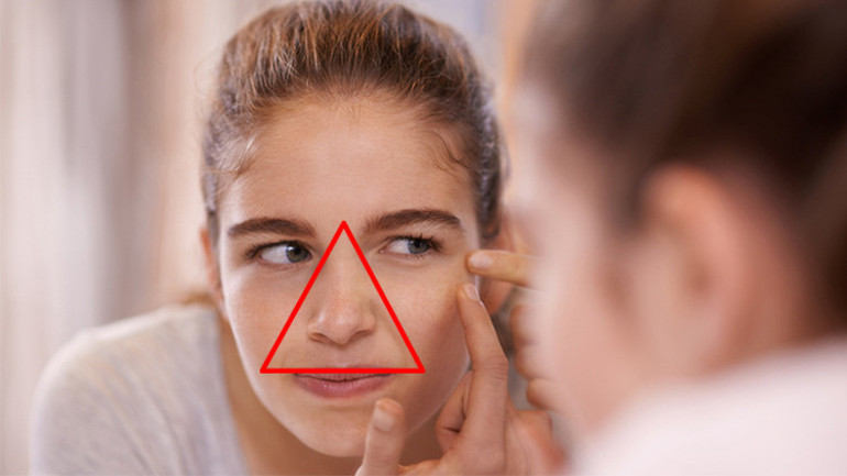 Sivilce sıkmak felce neden olur mu Özellikle tehlike üçgenine çok dikkat...