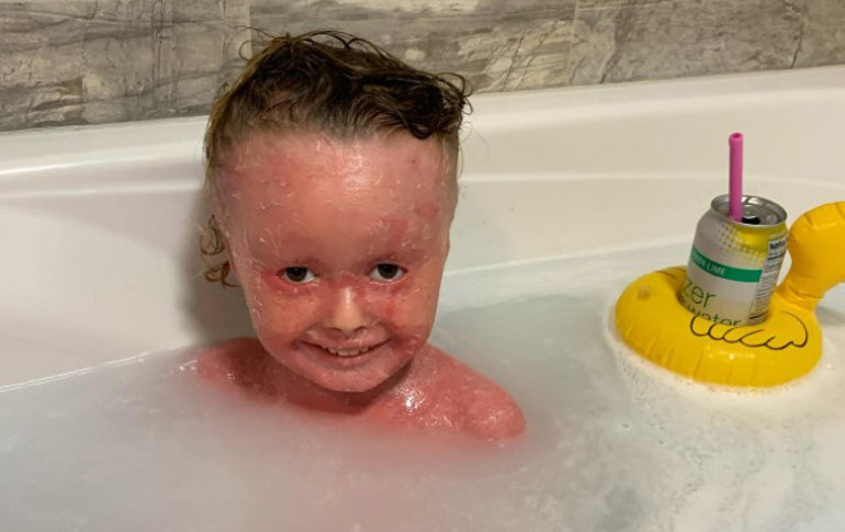 Her gün en az 3 saat banyo yapmak zorunda... 4 yaşındaki Annanın hikayesi...