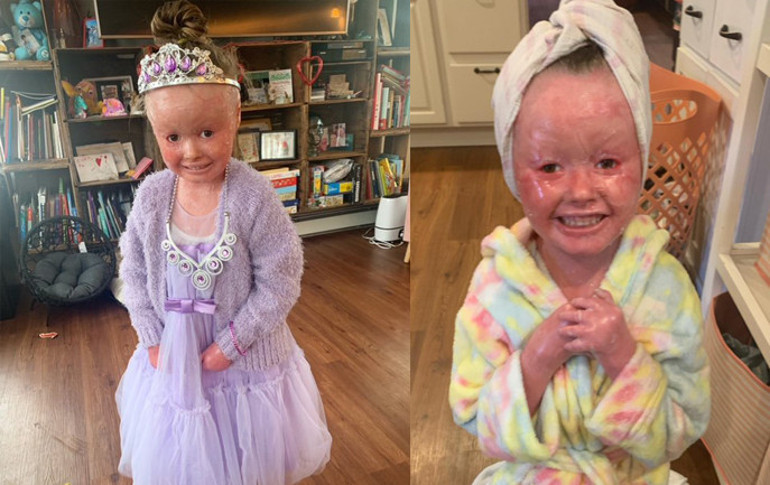 Her gün en az 3 saat banyo yapmak zorunda... 4 yaşındaki Annanın hikayesi...