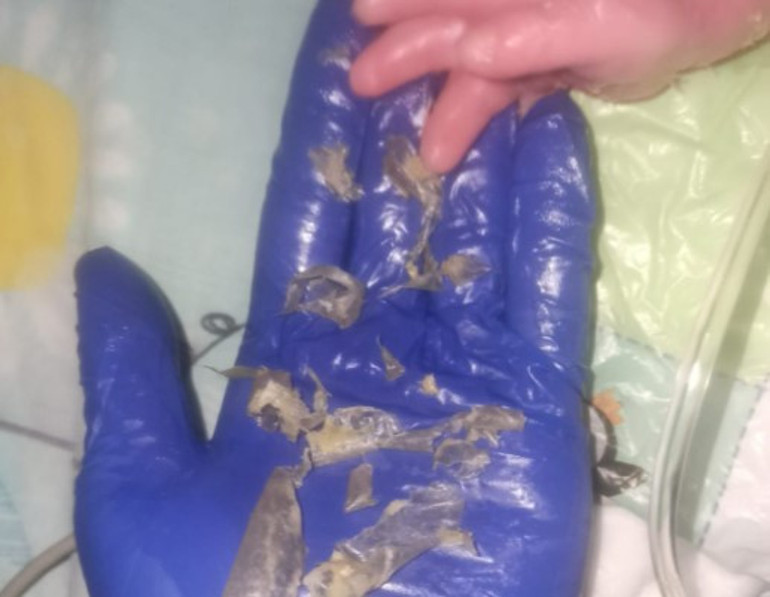 300 binde bir görülen bir hastalıkla doğan Gökdeniz bebeğin hikayesini annesi anlattı: Hayatımın en uzun 3 dakikasıydı