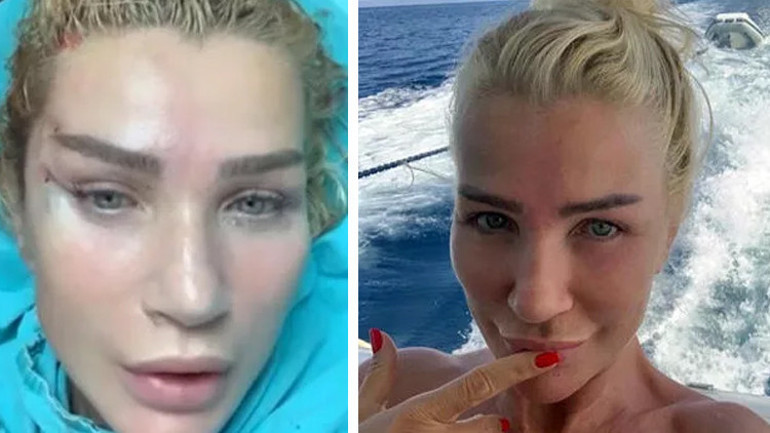 Umut Akyürek bıçak altına yattı: Alın daraltma ameliyatı geçirdim