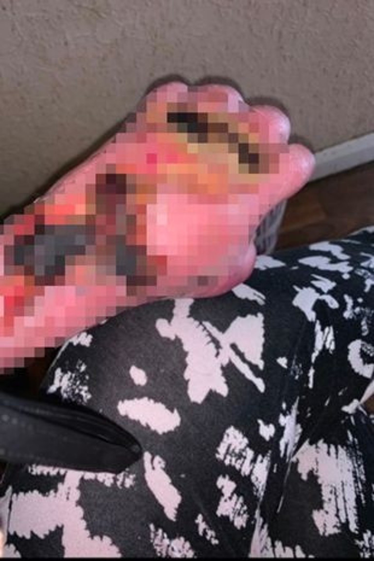 Hayat kurtarırken hayatı karardı… Doktorlara yalvarıyor: Lütfen kolumu kesin