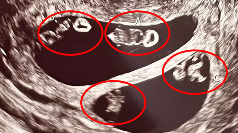 Ultrasona giren anne adayı hayatının şokunu yaşadı 70 milyonda bir görülüyor...