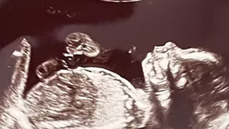 Ultrasona giren anne adayı hayatının şokunu yaşadı 70 milyonda bir görülüyor...