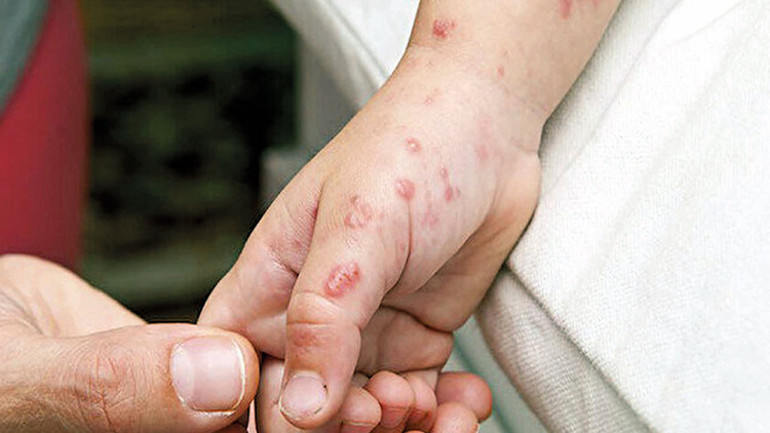 Korkutan maymun çiçeği virüsü Türkiyede