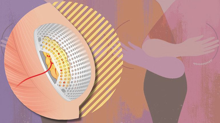 Meme silikonları tarihe mi karışıyor Meme kanseri sonrası devrim: ‘Bu umut verici bir gelişme’