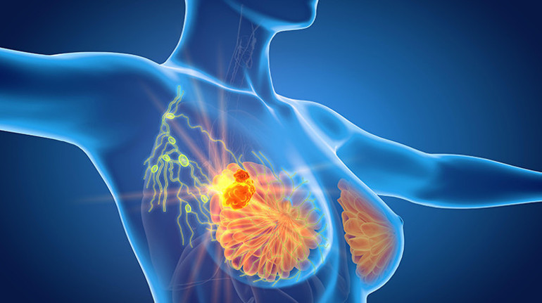 Meme silikonları tarihe mi karışıyor Meme kanseri sonrası devrim: ‘Bu umut verici bir gelişme’