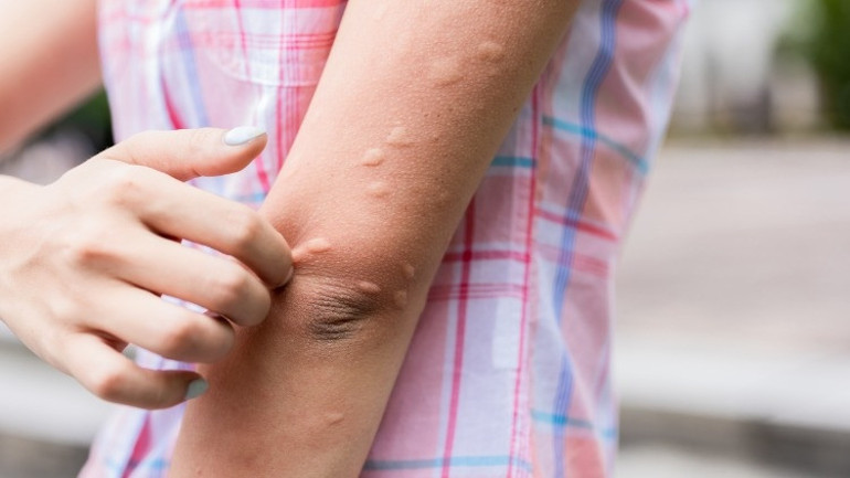 Aedes Sivrisinek Isırığı Belirtileri Nelerdir, Tedavisi Var Mı Aedes Sivrisinek Isırığından Korunmanın Yolları