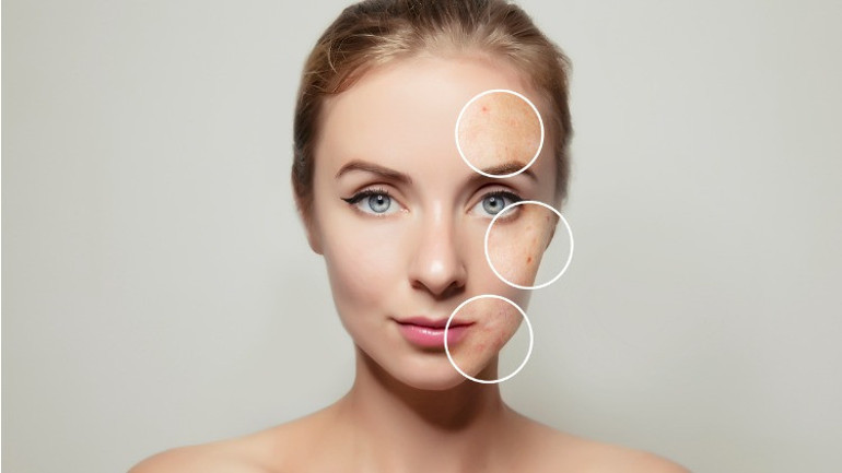 Sivilceler (akneler) nasıl tedavi edilir