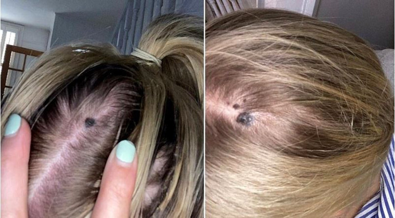 Kafasında çıkan benler için mantar teşhisi aldı, gerçek hastalığının melanom olduğu ortaya çıktı