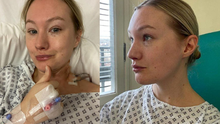 Kafasında çıkan benler için mantar teşhisi aldı, gerçek hastalığının melanom olduğu ortaya çıktı