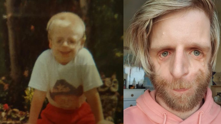 Ailesi görünüşü nedeni ile doğduktan 36 saat sonra terk etti Bir kız beni öptükten sonra hayatım değişti