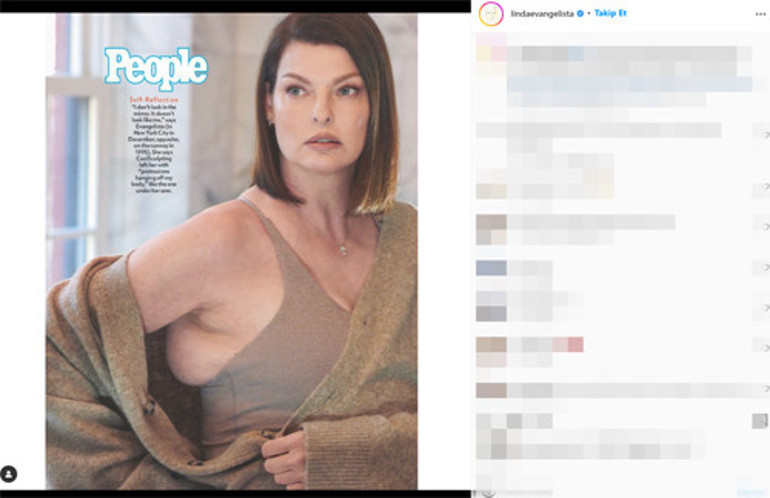 Güzellik uğruna estetik kurbanı olan top modelden acı itiraf: Reklamlara kandım, pişmanım