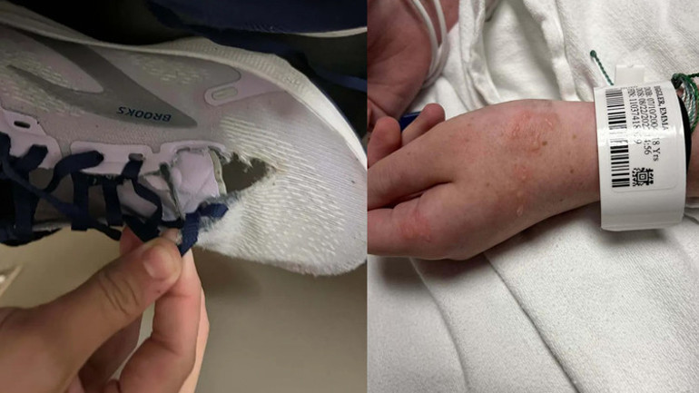 Okulun ilk gününde göğsüne yıldırım düştü Kıyafetleri erdi, saati patladı