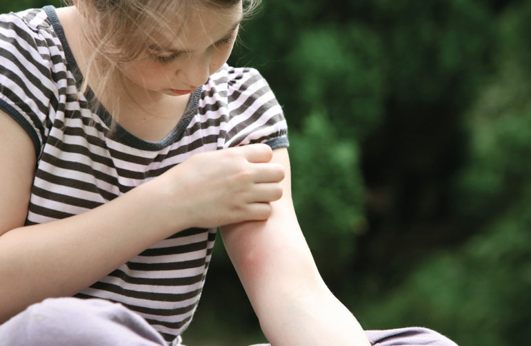 Sivrisinekler sanki bu yaz bir başka ısırıyor