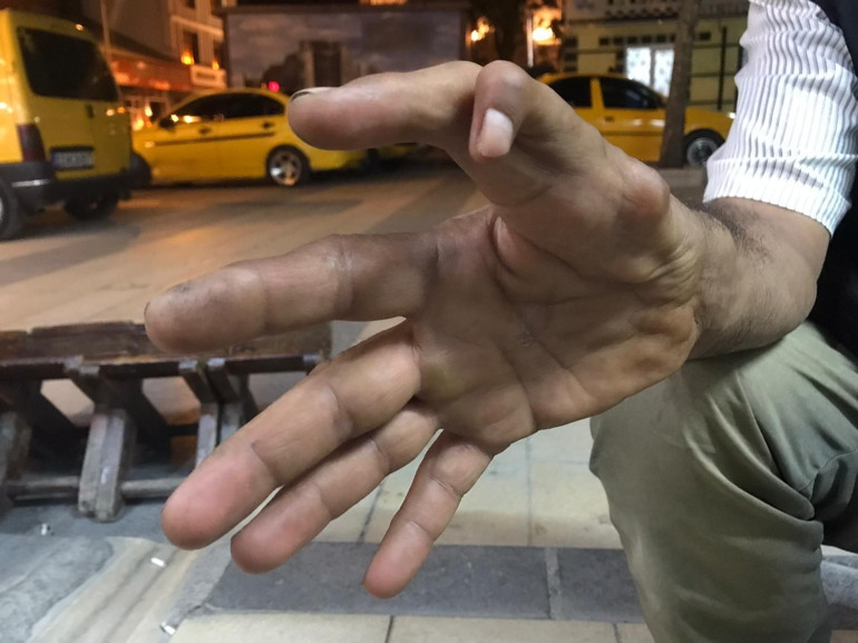 Elazığda 11 parmaklı adam görenleri hayrete düşürüyor